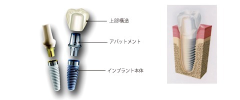 歯科矯正用アンカースクリュー(デュアル・トップオートスクリュー等)の構造