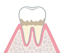 歯周病 進行状況 健康な状態
