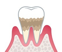 歯周病 進行状況 中度歯周病