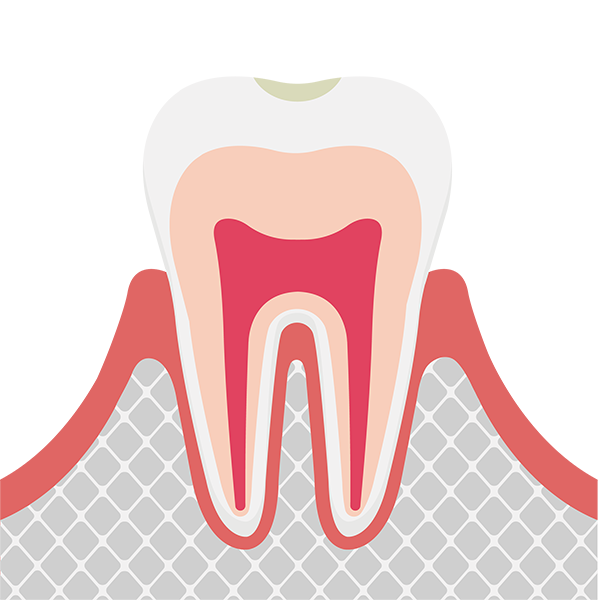初期段階の虫歯