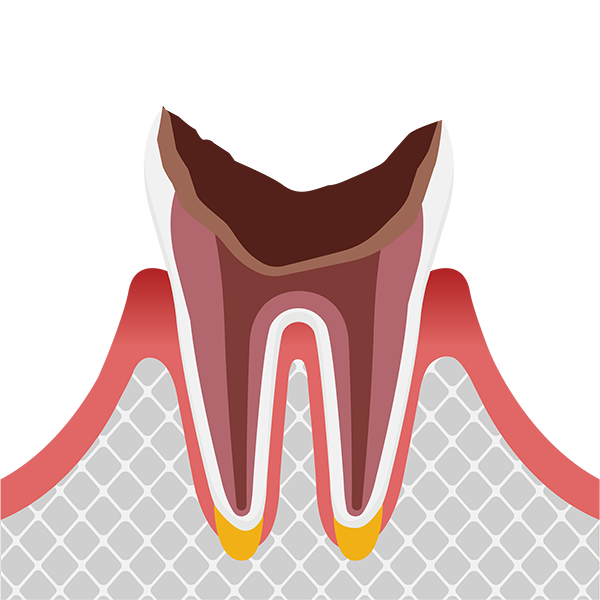 歯根まで達した虫歯