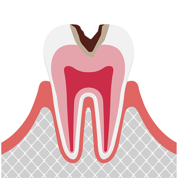 象牙質の虫歯