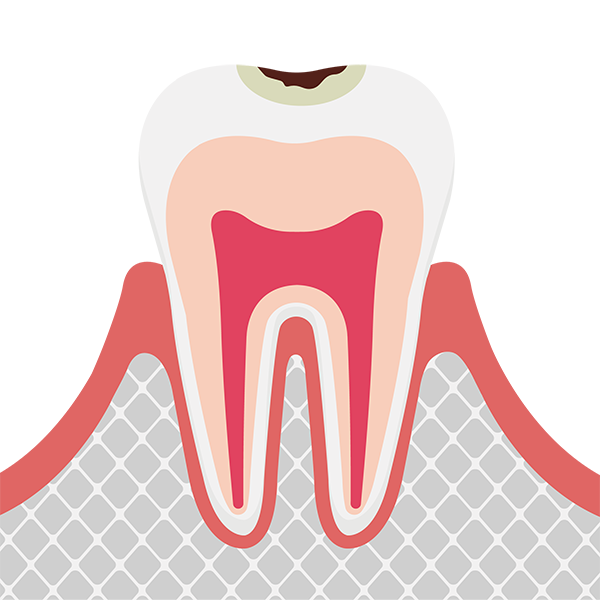 エナメル質の虫歯