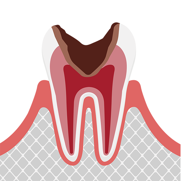 神経まで達した虫歯